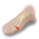 9 Common Causes of Pain in the Big Toe Joint