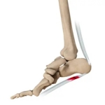 Can Plantar Fasciitis Go Away on Its Own?