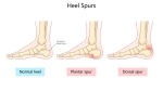 Heel Spurs: Symptoms, Causes, and Treatment