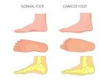 Stages of Charcot Foot: Symptoms, Diagnosis, and Treatment Explained