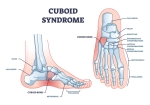 Cuboid Syndrome: Causes, Treatment Options & Recovery Guide