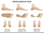 Flat Feet vs. Normal Feet: What’s the Difference?