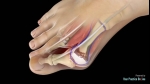 How to Get Rid of a Bunion