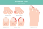 Ingrown Toenails: Causes, Symptoms, and Treatment
