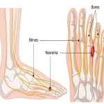 8 Morton's Neuroma Exercises to Decrease Foot Pain