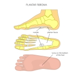 How to Treat a Plantar Fibroma