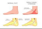 8 Effective Exercises for Tarsal Tunnel Syndrome