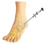 What Is Ankle Arthroscopy?