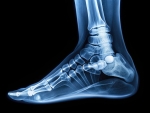 What Is Ankle Fusion Surgery? Procedure, Recovery, and Benefits
