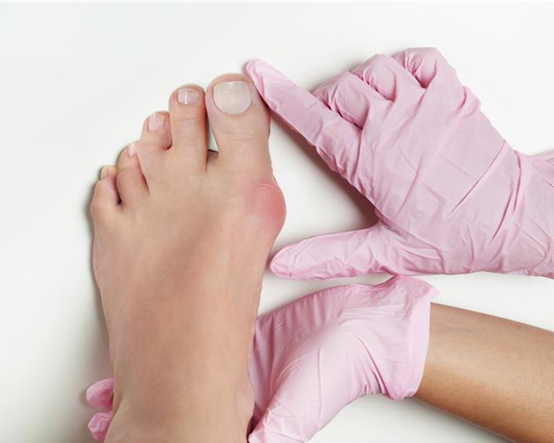 Bunions vs. Gout